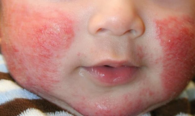 Cuida la piel de tu bebé, evita que sufra dermatitis