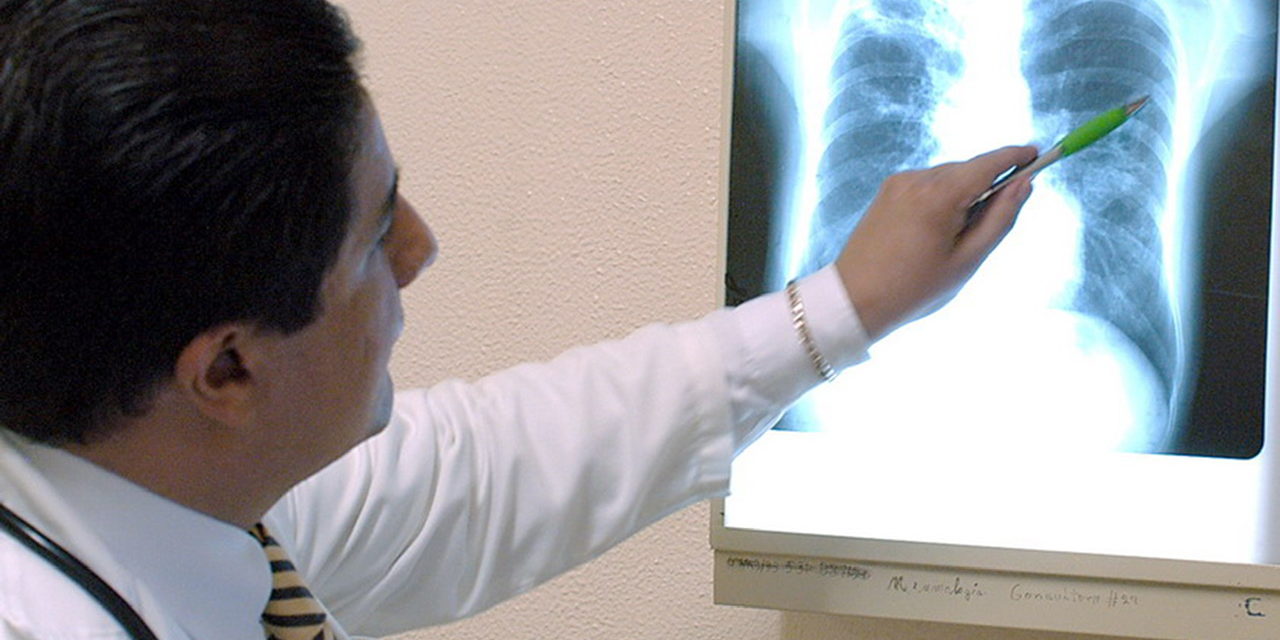 El Rincón del IMSS: ¿Qué es la tuberculosis?