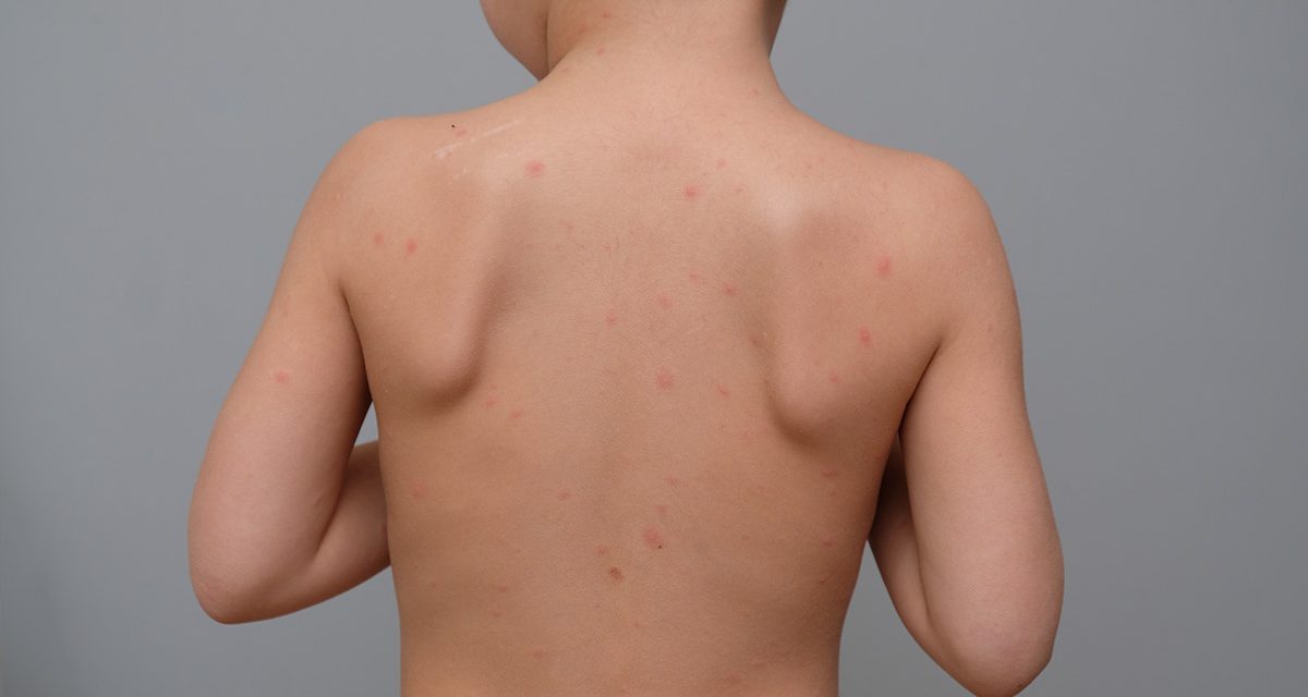 El Rincón del IMSS: ¿Qué tan severa es la varicela?