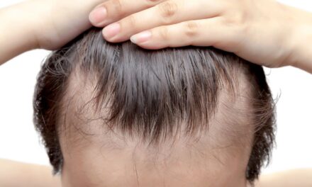 El Rincón del IMSS: ¿Qué causa la caída del cabello?