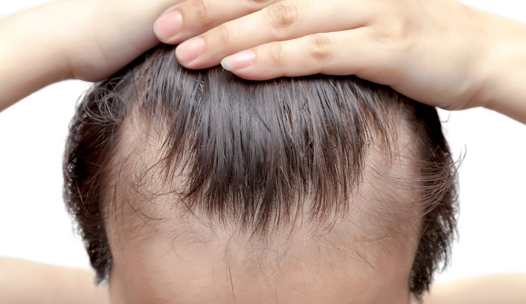 El Rincón del IMSS: ¿Qué causa la caída del cabello?