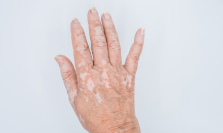 El Rincón del IMSS: Existen factores que deben evitarse para no desencadenar vitiligo